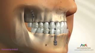 Orthodontic Treatment for Underbite or Crossbite  Bone Anchored Maxillary Protraction [upl. by Anirbas]