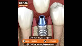 Dental Implants A Permanent Solution for Missing Teeth dentalimplants dentalhealth [upl. by Ericha]