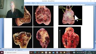 Orthopaedic in Arabic 62  Osteogenic sarcoma  pathology  by DrWahdan [upl. by Enajharas]