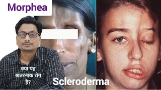 Morphea  Localized Scleroderma क्या यह ख़तरनाक बिमारी है morphea scleroderma systemicsclerosis [upl. by Eiraminot]