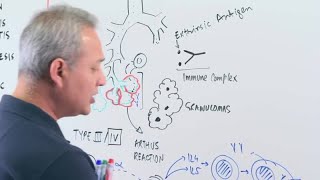 Hypersensitivity Pneumonitis [upl. by Shaw]