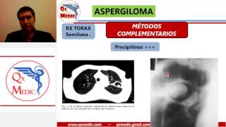 ASPERGILOMA [upl. by Lafleur]