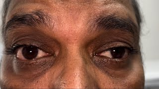 Myasthenia Gravis eye signs [upl. by Eaton320]