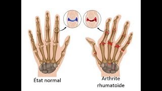 L’arthrite rhumatoïde  comment en contrôler les symptômes [upl. by Elleval]