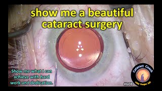 Superficial Keratectomy [upl. by Niram478]