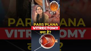 What is Pars plana Vitrectomy [upl. by Llehcor109]