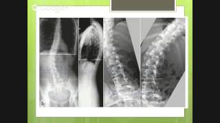 Neurocirugía Universidad de Antioquia  Escoliosis Idiopatica del Adulto [upl. by Mota]