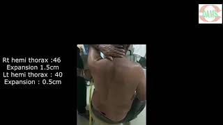 Palpation of chest by Dr Bharath Kathi DAMS Faculty [upl. by Neik883]