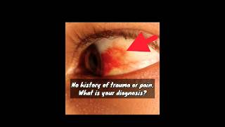 Subconjunctival Hemorrhage mbbs neetpg [upl. by Kristianson]