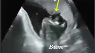 16 WEEK BOY GENDER BABY ULTRASOUND GUIDED VIDEOA NEW CONCEPTION ULTRASOUND STUDIO IN MA [upl. by Irmgard]