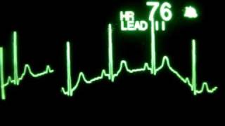 Sinus Rhythm with Respirations [upl. by Lavelle]