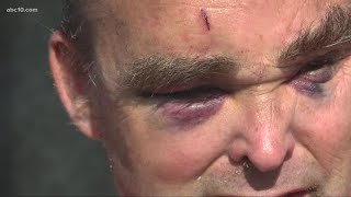 Autistic man left with bruised eyes after being attacked while walking in South Sacramento [upl. by Graybill323]