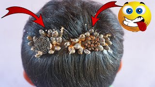 How to check a boys head for head lice [upl. by Nibbor240]