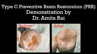 Type C Preventive Resin Restoration PRRDemonstration by Dr Amita Rai [upl. by Charisse]