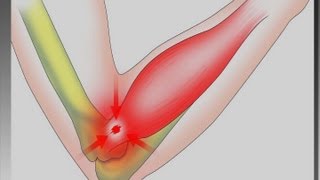 Tennisarmbåge  en ergonomisk utmaning [upl. by Nodnol768]