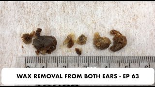 EAR WAX REMOVAL FROM BOTH EARS  EP 63 [upl. by Caryl]