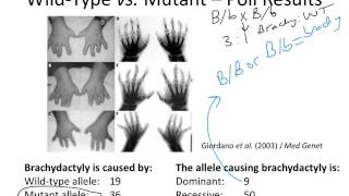 brachydactyly [upl. by Eignav]