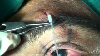 PTOSIS SURGERY VIA SUPRABROW SINGLE STAB INCISIONnew technique frontalis sling Soosan Jacobmpg [upl. by Melisse]