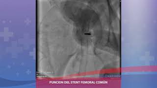 Angioplastia periférica compleja de lesión calcificada de arteria iliaca primitiva derecha [upl. by Froemming]