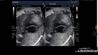 Truncus arteriosus or CAT fetus ultrasound video echocardiography [upl. by Rosco]