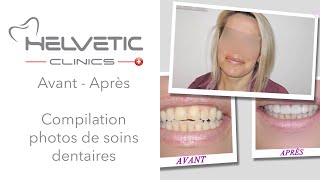 Avant Après  Compilation photos de soins dentaires [upl. by Zeugirdor166]