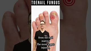 How to Know If Toenail Fungus is Dying How Fast Do Nails Grow [upl. by Litt]