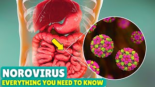 Norovirus Explained Causes Symptoms and How to Recover Fast [upl. by Katonah]