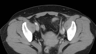 Diverticulitis Ahuja AT et al 2017 Book Essential Radiology [upl. by Ahsiken865]