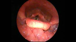 Videolaryngoscopy  Laryngopharyngeal reflux [upl. by Esmaria]