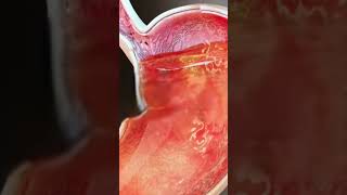 Stomach Acid Relux stomach acidity shorts [upl. by Lajib]