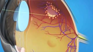 Retinal Tear Surgery [upl. by Kraul]