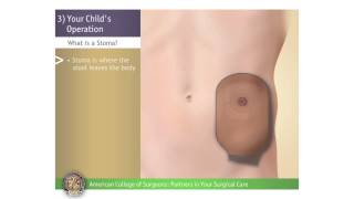 Pediatric ColostomyIleostomy Your Childs Operation [upl. by Jordana]