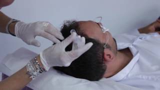 Traitement de la chute des cheveux par microneedling et lampe LED [upl. by Saqaw]