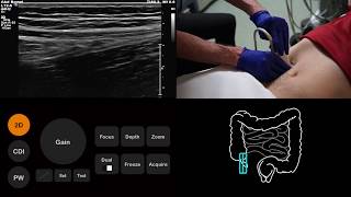 Ultrasound Tutorial AppendixAppendicitis  Radiology Nation [upl. by Silverts120]