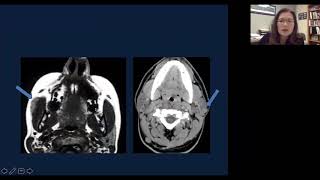 Imaging of the parotid gland Part 1  Health4TheWorld Academy [upl. by Gizela]