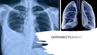 Derrame Pleural conhecendo o mecanismo fisiopatológico e ações de enfermagem [upl. by Aninaj]