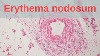 What is Erythema Nodosum  Pathology mini tutorial [upl. by Ettevi]