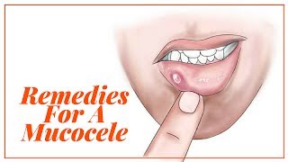 HOME REMEDIES FOR A MUCOCELE [upl. by Roch148]