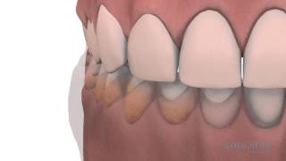 Gingivoplasty and gingivectomy  Lapointe dental centres [upl. by Aliuqet]