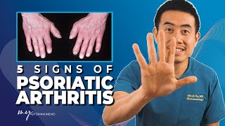 5 Signs of Psoriatic Arthritis How to know if you have psoriatic arthritis  Dr Micah Yu [upl. by Esinehs294]