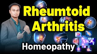 Rheumtoid Arthritis Chronic Inflammatory Arthritis  Dr Bharadwaz  HomeopathyTreatment and Cure [upl. by Anavlys532]