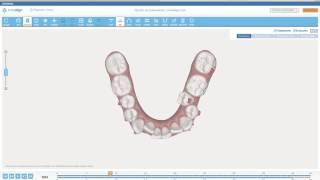 UPPER AND LOWER MOLAR DISTALIZATION [upl. by Einehpets]