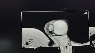 Testicular  scrotal diagnostic dilemma  MRI findings [upl. by Huxham]