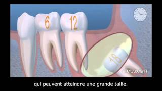 Les troisièmes molaires ou dents de sagesse [upl. by Dione]