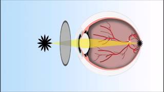 Presbyopia Explained Annimated Video [upl. by Suraved]