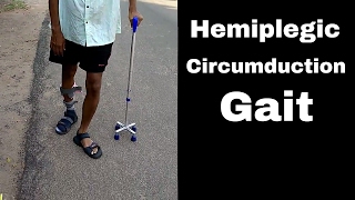 How does a Hemiplegic Walks in Circumduction Gait [upl. by Atnamas]