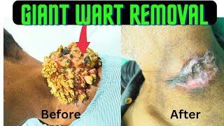 Very Big Wart on Neck wart removal Result after 2 weeks Wart removal in Ranchi wart wartremoval [upl. by Averell590]