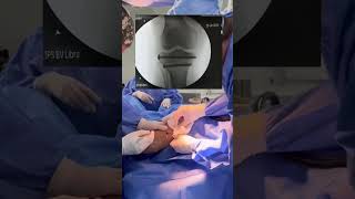 FRACTURA DE MESETA TIBIAL CON CIRUGÍA MÍNIMA MESETATIBIAL DOCTORJUANCARLOSALBORNOZ [upl. by Fortunato419]