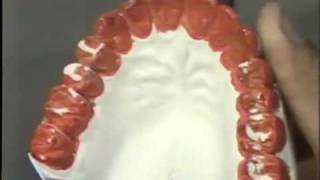 Occlusal Adjustment  Protrusive Movement [upl. by Alihs943]