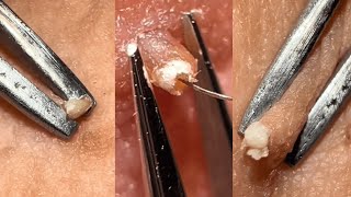 😱 2024s Extreme Beauty Treatments Satisfying Relaxing asmr pimple [upl. by Butterfield65]